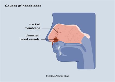 How To Control Nose Bleeds - Clockscheme Spmsoalan