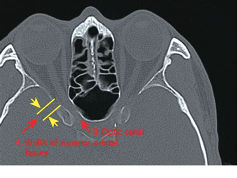 Figure 1 from A Statistical Analysis of Superior Orbital Fissure Width ...