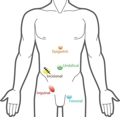 Can An Incisional Hernia Cause Back Pain