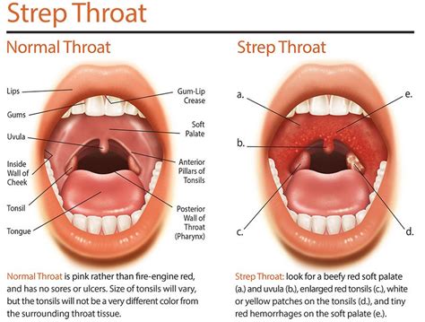 Streptococcal - Mahaba Herbal Limited