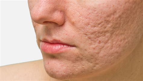 Acne Scarring – Edge Clinic