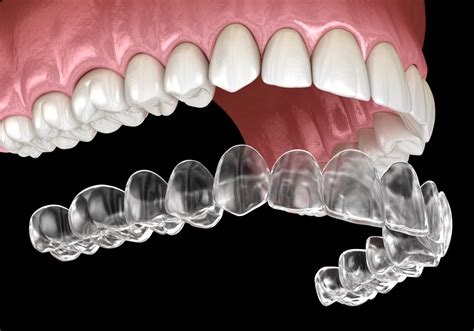 Can You Get Invisalign for Just Your Top Teeth? - Saskatoon Smiles