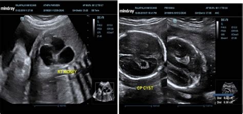 Sample ultrasound image for normal fetal | Download Scientific Diagram