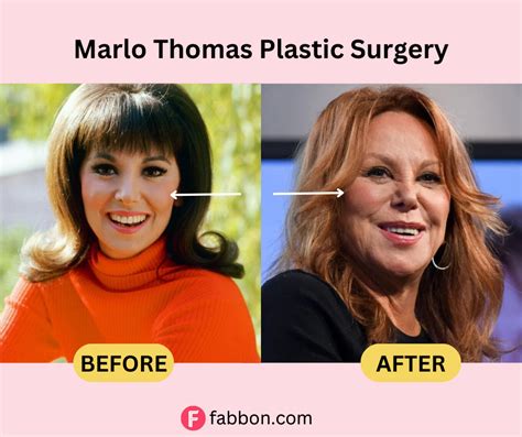 Marlo Thomas Plastic Surgery Secrets: Before And After Photos | Fabbon