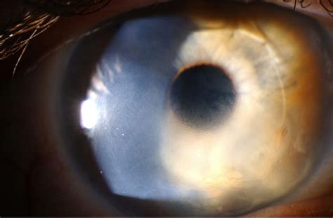 Moran CORE | Corneal Decompensation Secondary to Verisyse Lens Implantation