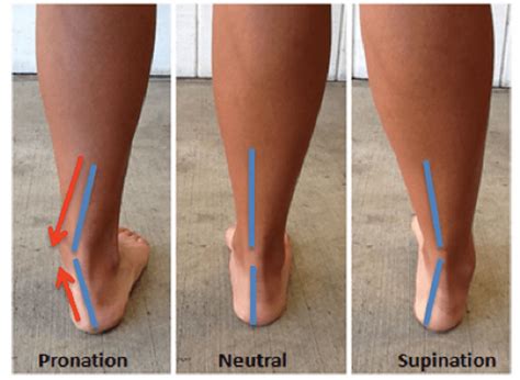 How Pronation, Overpronation, and Supination Affect You