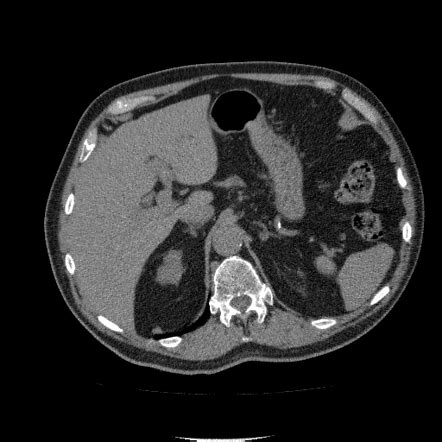 Vesicoureteric junction calculi in duplex ureter | Radiology Case ...