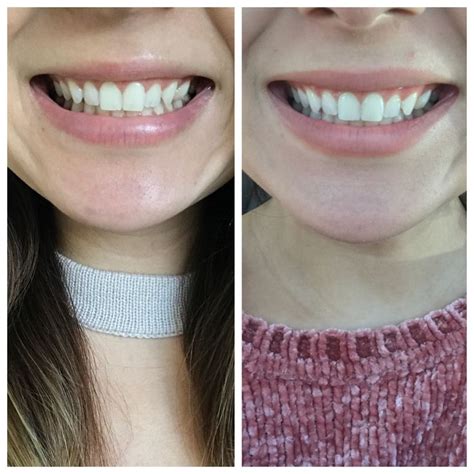 Pin on teeth whitening before and after