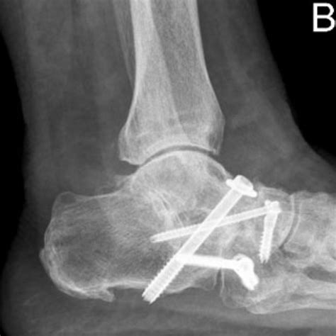 ankle-triple-arthrodesis - BallaratOSM | Ballarat Orthopaedics & Sports ...