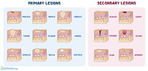 Macule Vs Papule