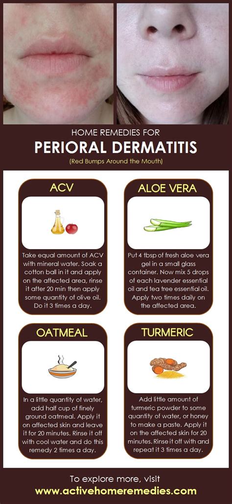 Home Remedies for Perioral Dermatitis (Red Bumps Around the Mouth ...