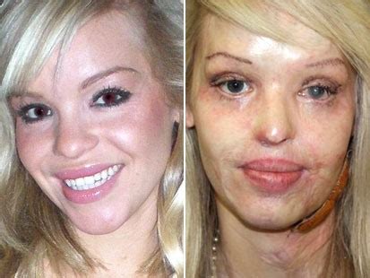 Katie Piper: British Model Burned in Sulfuric Acid Attack - ABC News