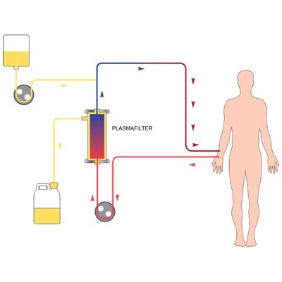 Plasmapheresis: Procedure Information & Potential Complications — Know Rare