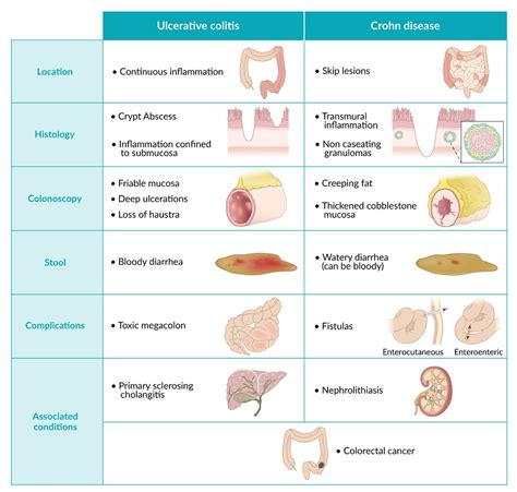 Ulcerative Colitis Symptoms Causes Treatment