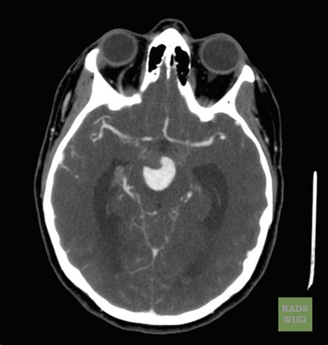 Cerebral aneurysm CT - wikidoc