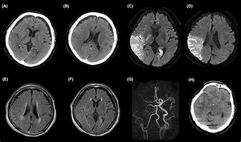 A case of acute cerebral infarction associated with an accessory middle ...