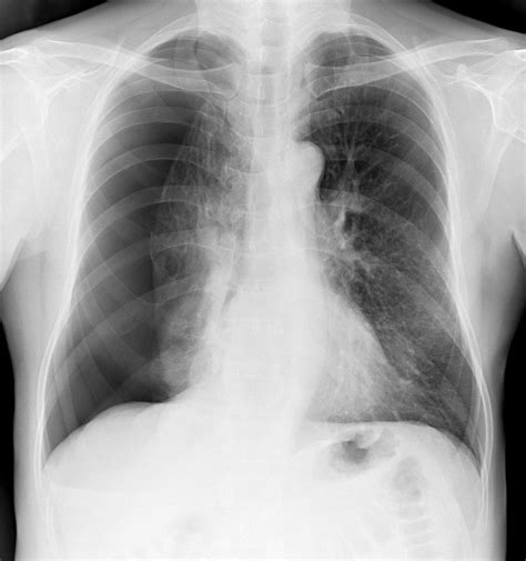 Colapso pulmonar: MedlinePlus en español