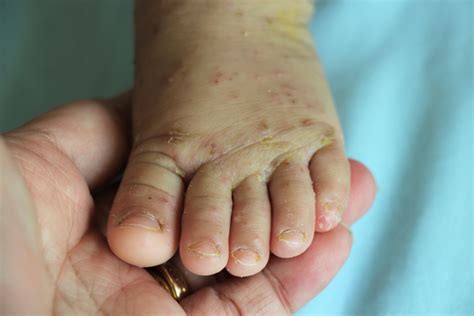 Scabies In Babies: Causes, Symptoms And Treatment - Being The Parent