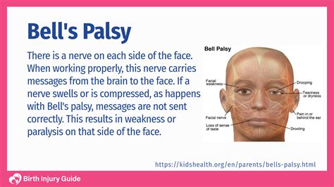 Bell's Palsy Handbook: Facial Nerve Palsy Or Bell's Palsy Facial ...