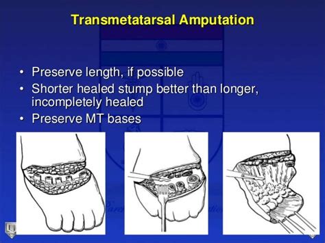 Lecture 31 parekh amputations