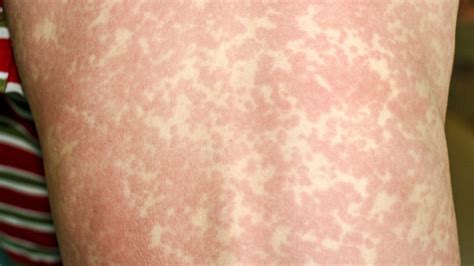 Is that a Mono Rash: How to Know If That Rash Means Mono