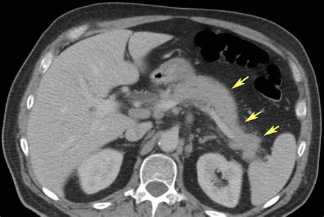 RiT radiology: Autoimmune Pancreatitis