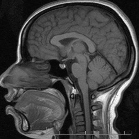 Pituitary microadenoma : dynamic MRI | Radiology Case | Radiopaedia.org