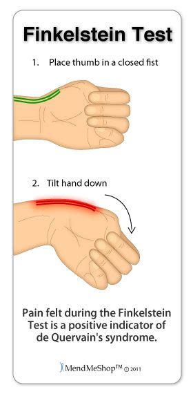 Dealing with De Quervain’s | Physio Fusion