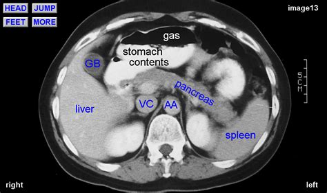 normal CT abdominal with label | Abdomen, Organs, Abdominal