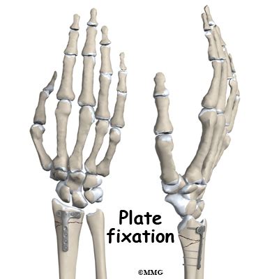 Adult Wrist Fractures - Midwest Bone and Joint Institute - Illinois