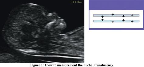 Figure 1 from VARIATION OF NUCHAL TRANSLUCENCY MEASUREMENT IN FIRST ...