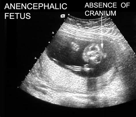 Anencephaly