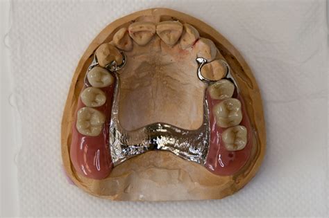 Dentures – Ryde Dental Practice