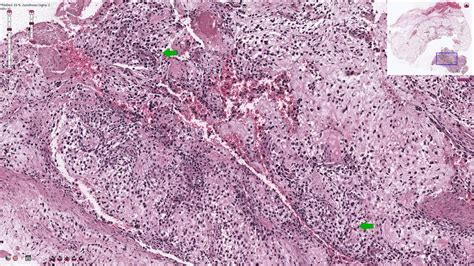 Histology Of Osteosarcoma