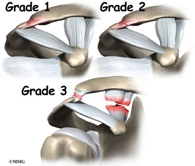 Acromioclavicular Joint Separation - Orthogate