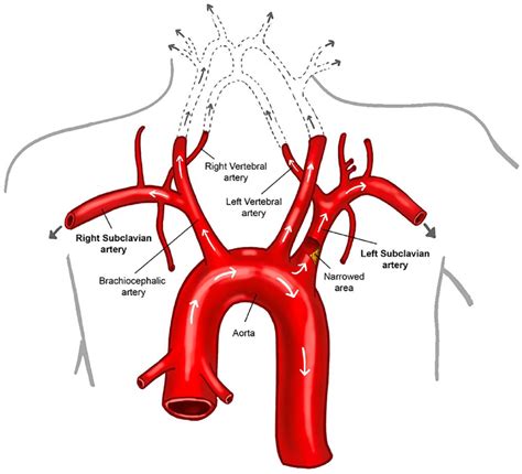 Vascular Disease Patient Information Page: Subclavian artery stenosis ...