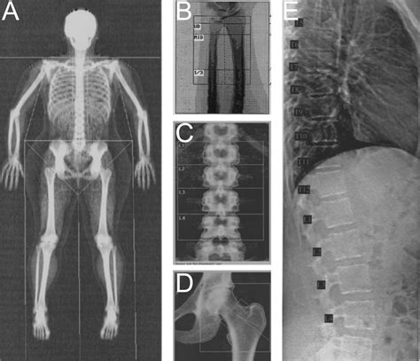 Sample DXA images. Bone density, mass, and area are calculated for each ...