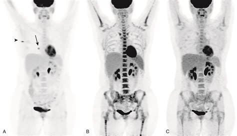 Breast Cancer Metastases-Bone | PracticeUpdate