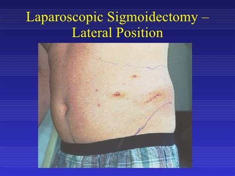 Laparoscopic Sigmoid Colon Resection for Diverticular Disease