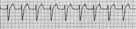 Accelerated idioventricular rhythm at a rate of approximately 80 beats ...