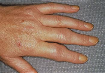 Rheumatoid Arthritis Symptoms : Johns Hopkins Arthritis Center