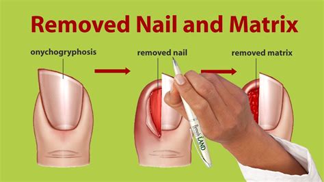 Nail Removal, Treatment for Onychogryphosis - YouTube