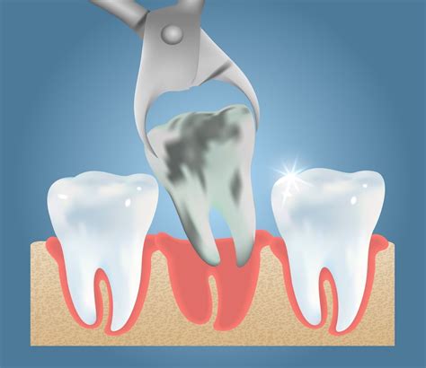 Tooth Extractions - Normandy/Lakewood Dentistry - Jacksonville, FL