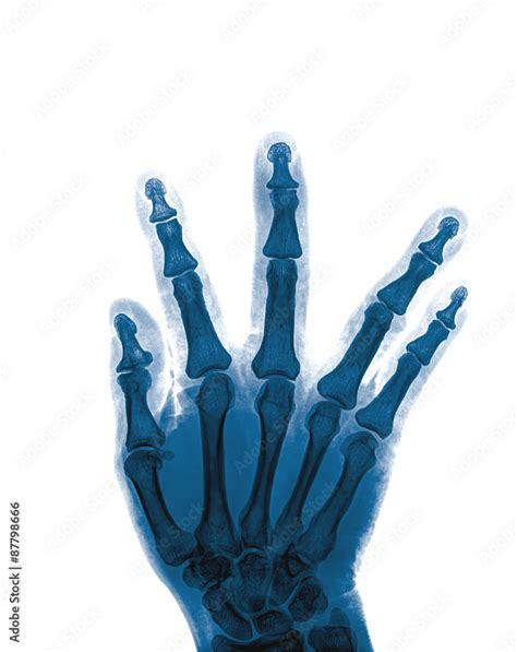 X-ray of hand fractures Stock Photo | Adobe Stock