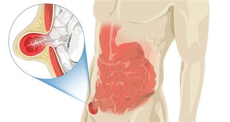 Inguinal hernia - Symptoms, Causes and Treatment