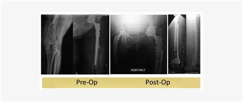 Left Periprosthetic Femur Fracture Operated By Dr Dshekhar - Radiology ...