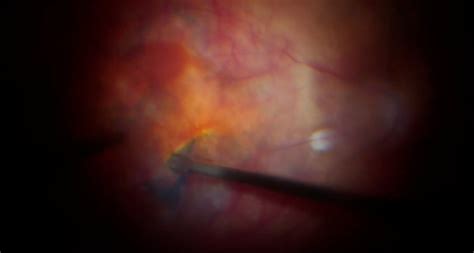 Pars Plana Vitrectomy in Myopic Traction Maculopathy - Eyetube