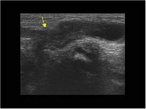 Pediatrics | 9.1 Pediatric abdomen and retroperitoneum : Case 9.1.10 ...