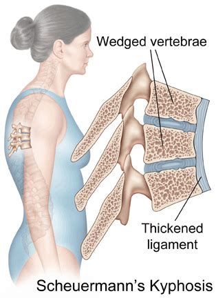 Scheuermann's Kyphosis -Redlands, Loma Linda, Highland | Bones and ...