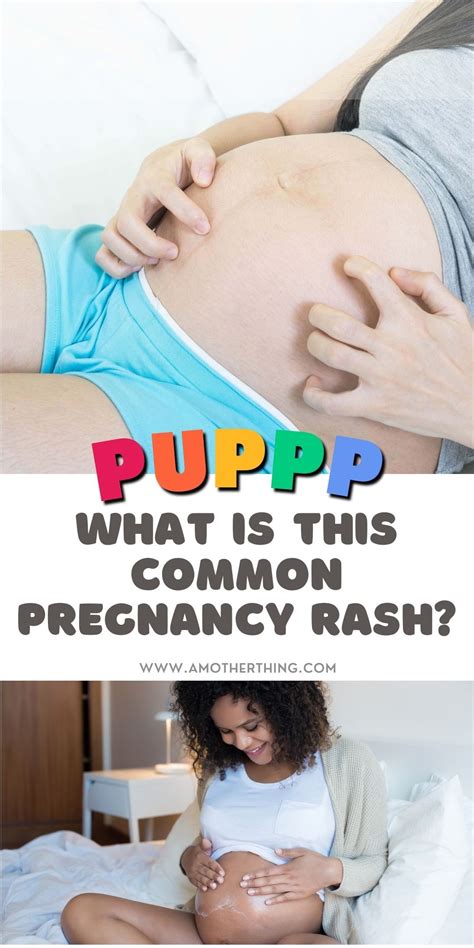 PUPPP Rash: Definition, Symptoms, Causes, & Treatment